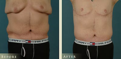 Male Body Lift Before & After Gallery - Patient 162850 - Image 1