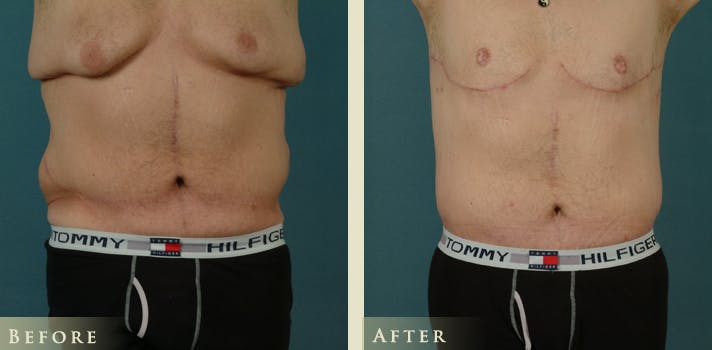Male Body Lift Before & After Gallery - Patient 162850 - Image 1