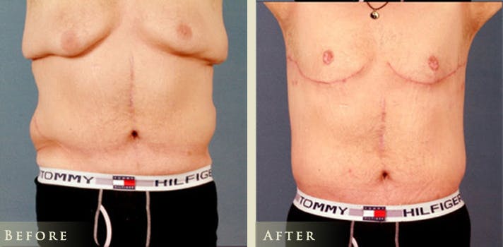 Male Breast Reduction (Gynecomastia) Before & After Gallery - Patient 114118 - Image 2