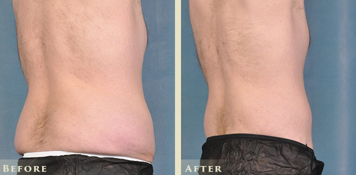 Male Liposuction Before & After Gallery - Patient 160216 - Image 6