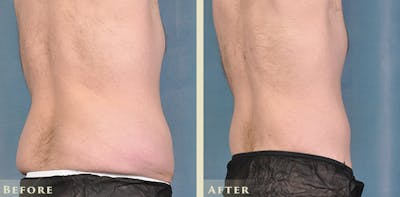 Male Liposuction Before & After Gallery - Patient 160216 - Image 6
