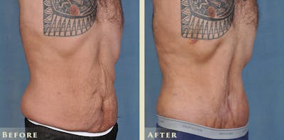 Male Tummy Tuck Before & After Gallery - Patient 205318 - Image 2