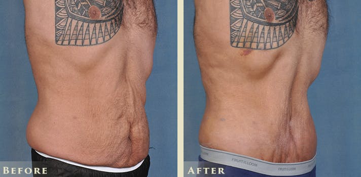 Male Tummy Tuck Before & After Gallery - Patient 205318 - Image 2