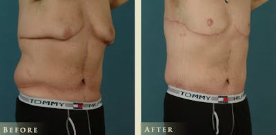 Male Body Lift Before & After Gallery - Patient 162850 - Image 2