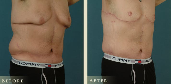 Male Body Lift Before & After Gallery - Patient 162850 - Image 2