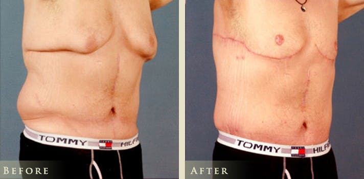 Male Breast Reduction (Gynecomastia) Before & After Gallery - Patient 114118 - Image 3