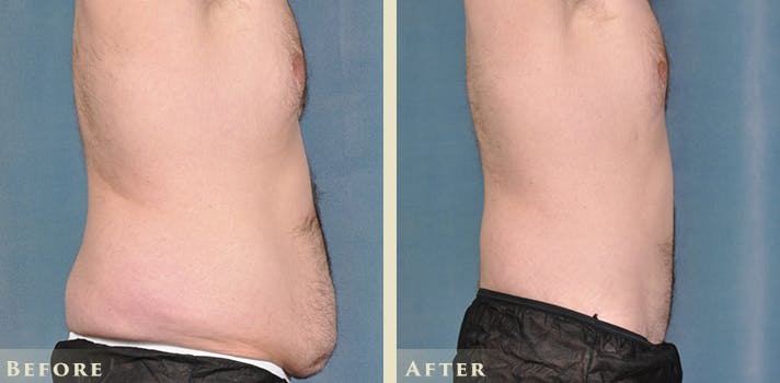 Male Liposuction Before & After Gallery - Patient 160216 - Image 7