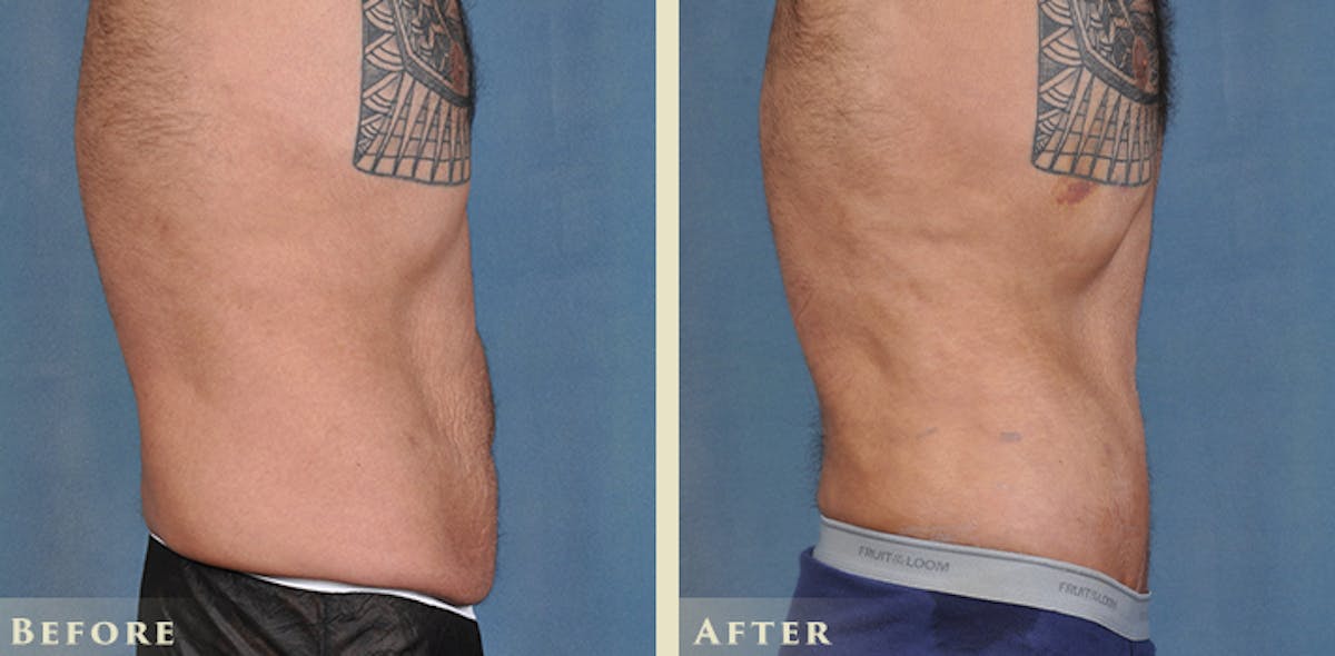 Male Tummy Tuck Before & After Gallery - Patient 205318 - Image 3