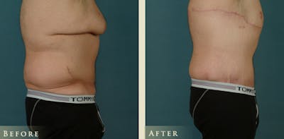 Male Body Lift Before & After Gallery - Patient 162850 - Image 3