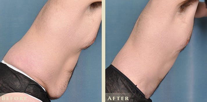 Male Liposuction Before & After Gallery - Patient 160216 - Image 8