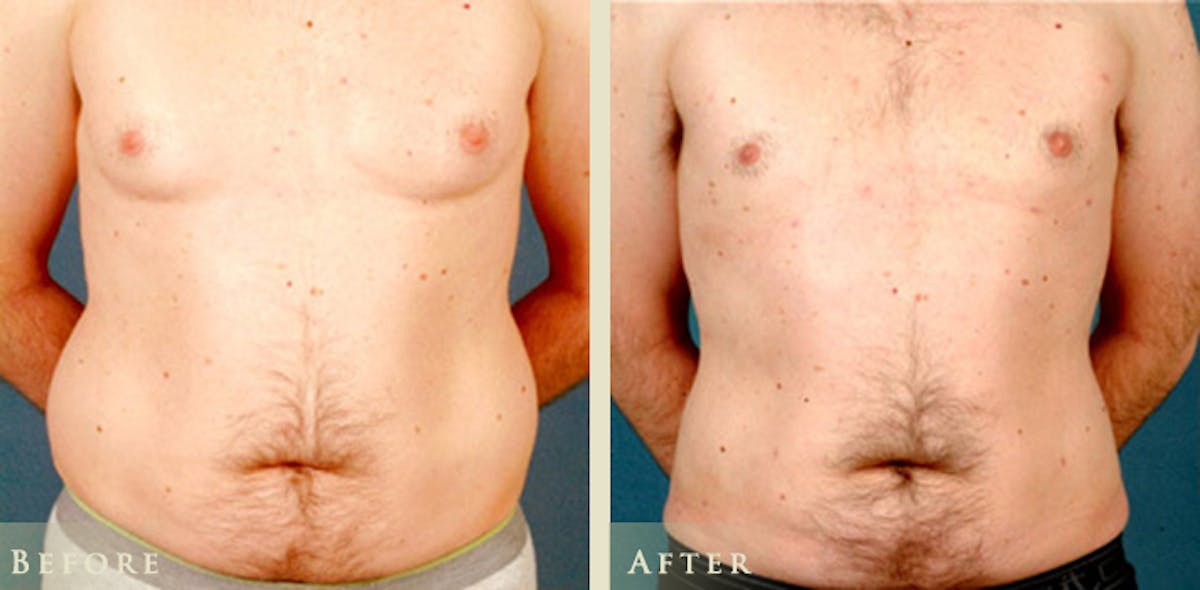 Male Breast Reduction (Gynecomastia) Before & After Gallery - Patient 139376 - Image 1