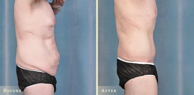 Male Body Lift Before & After Gallery - Patient 481519 - Image 1
