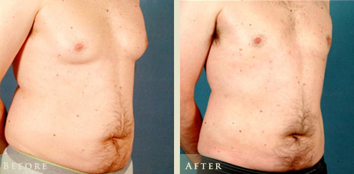 Male Breast Reduction (Gynecomastia) Before & After Gallery - Patient 139376 - Image 2