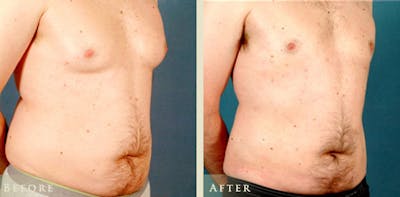 Male Breast Reduction (Gynecomastia) Before & After Gallery - Patient 139376 - Image 2