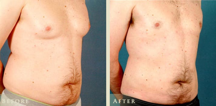 Male Breast Reduction (Gynecomastia) Before & After Gallery - Patient 139376 - Image 2
