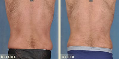 Male Tummy Tuck Before & After Gallery - Patient 205318 - Image 5