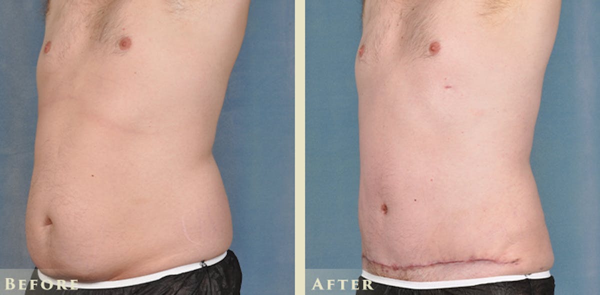 Male Liposuction Before & After Gallery - Patient 306119 - Image 2
