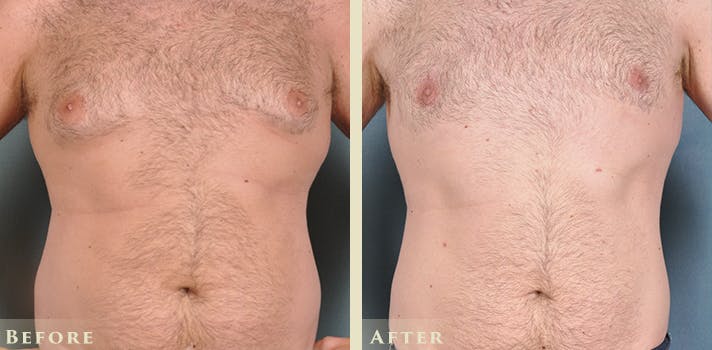 Male Breast Reduction (Gynecomastia) Before & After Gallery - Patient 167450 - Image 1
