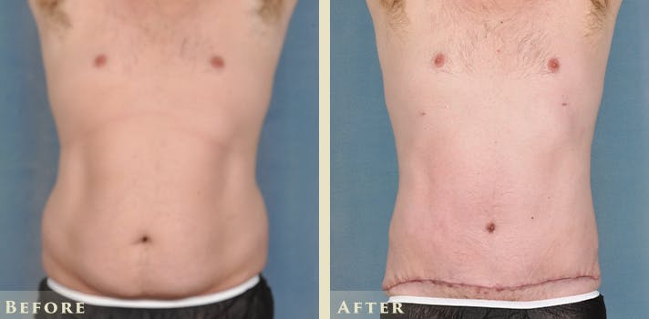 Male Tummy Tuck Before & After Gallery - Patient 414478 - Image 1