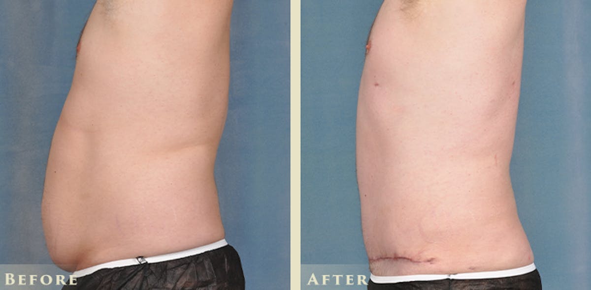 Male Liposuction Before & After Gallery - Patient 306119 - Image 3