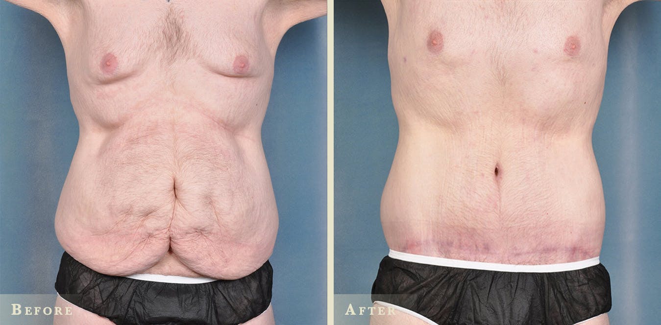 Male Body Lift Before & After Gallery - Patient 481519 - Image 3