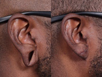 Earlobe Repair Before & After Gallery - Patient 322164 - Image 1