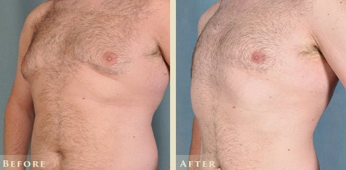 Male Breast Reduction (Gynecomastia) Before & After Gallery - Patient 167450 - Image 2