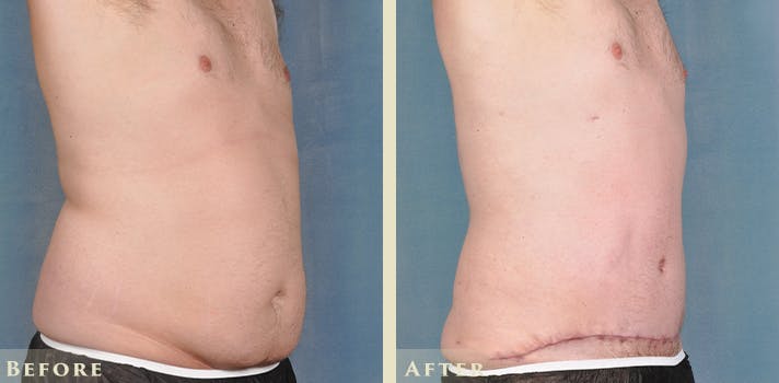 Male Liposuction Before & After Gallery - Patient 306119 - Image 4