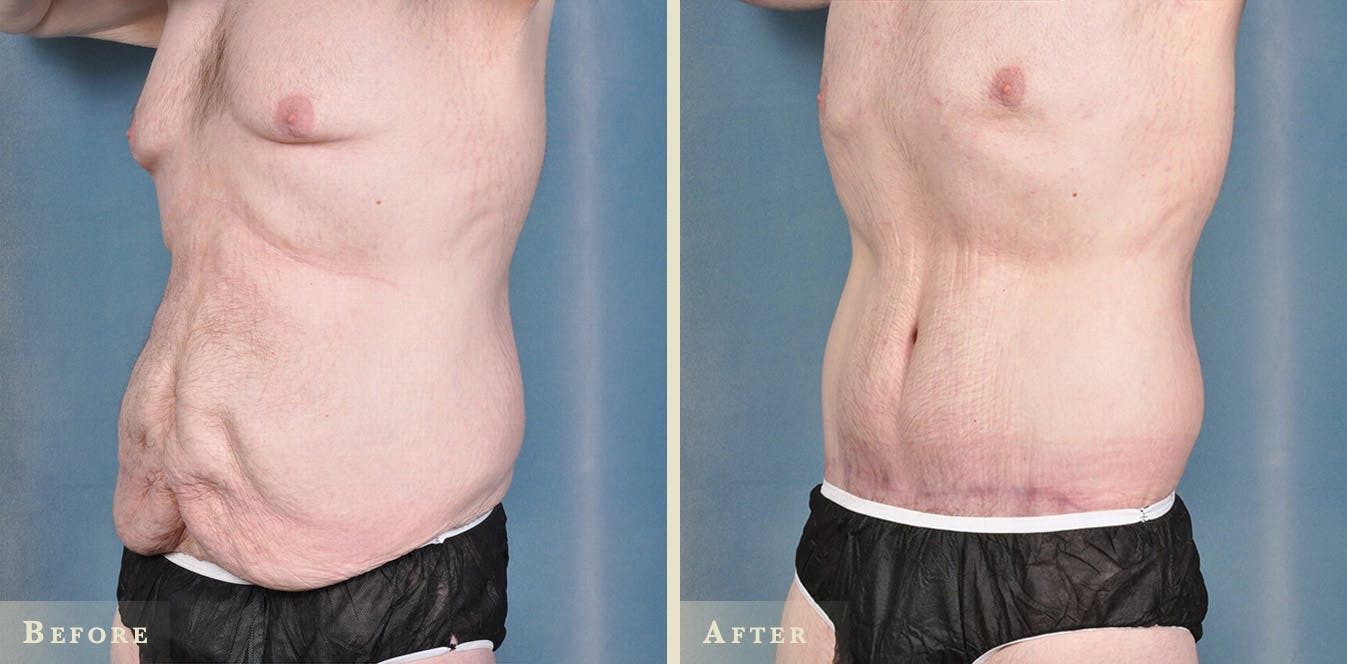 Male Body Lift Before & After Gallery - Patient 481519 - Image 4
