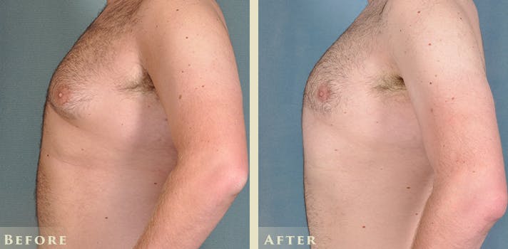 Male Breast Reduction (Gynecomastia) Before & After Gallery - Patient 167450 - Image 3