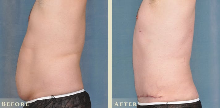 Male Tummy Tuck Before & After Gallery - Patient 414478 - Image 3