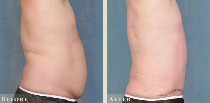 Male Liposuction Before & After Gallery - Patient 306119 - Image 5
