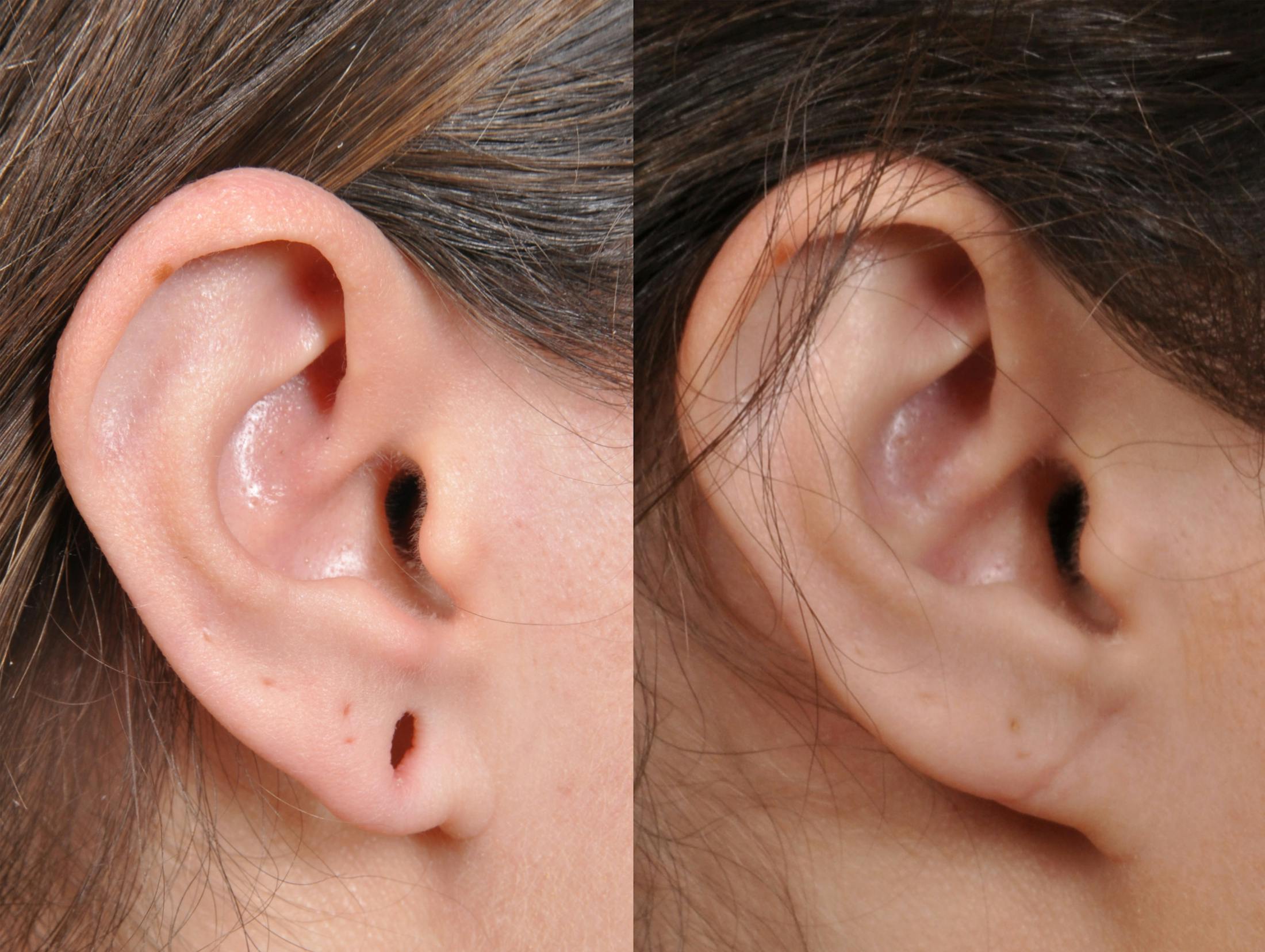 Earlobe Repair Before & After Gallery - Patient 184904 - Image 1
