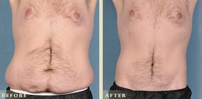 Male Body Lift Before & After Gallery - Patient 404742 - Image 1