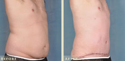 Male Tummy Tuck Before & After Gallery - Patient 414478 - Image 4