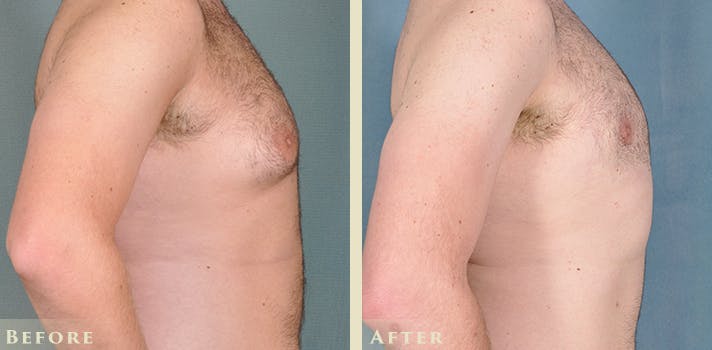 Male Breast Reduction (Gynecomastia) Before & After Gallery - Patient 167450 - Image 4