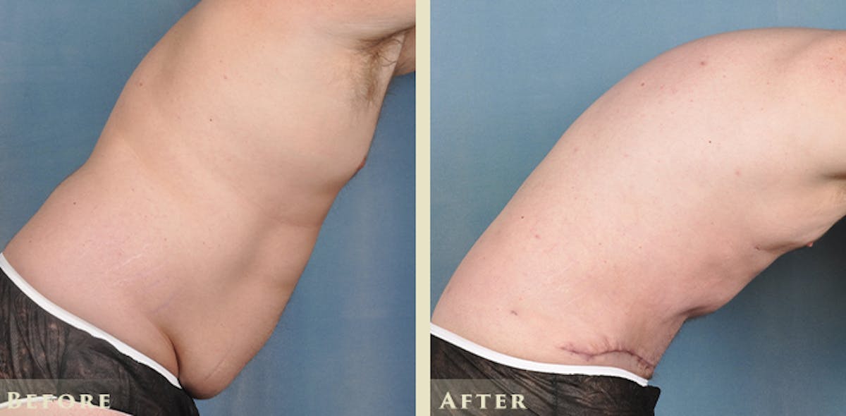 Male Liposuction Before & After Gallery - Patient 306119 - Image 6