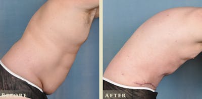 Male Liposuction Before & After Gallery - Patient 306119 - Image 6
