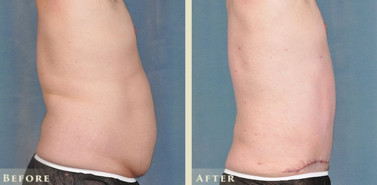 Male Tummy Tuck Before & After Gallery - Patient 414478 - Image 5