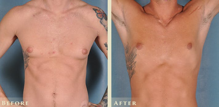 Male Breast Reduction (Gynecomastia) Before & After Gallery - Patient 639084 - Image 1