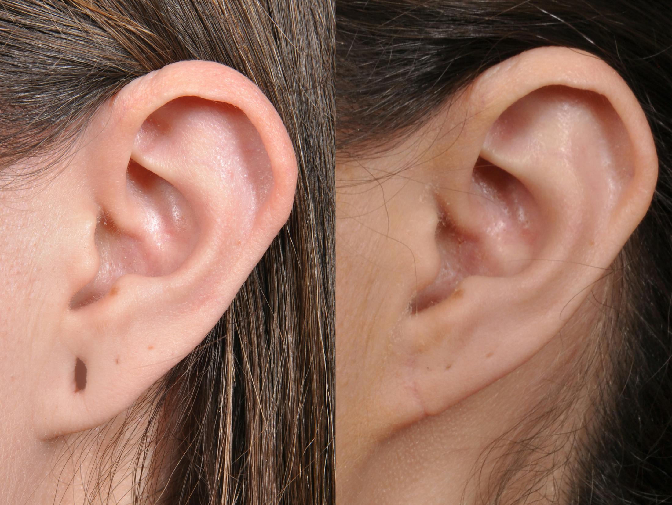 Earlobe Repair Before & After Gallery - Patient 184904 - Image 2