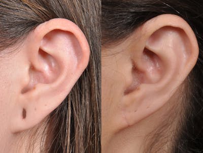 Earlobe Repair Before & After Gallery - Patient 184904 - Image 2