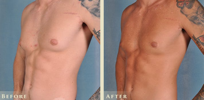 Male Breast Reduction (Gynecomastia) Before & After Gallery - Patient 639084 - Image 2