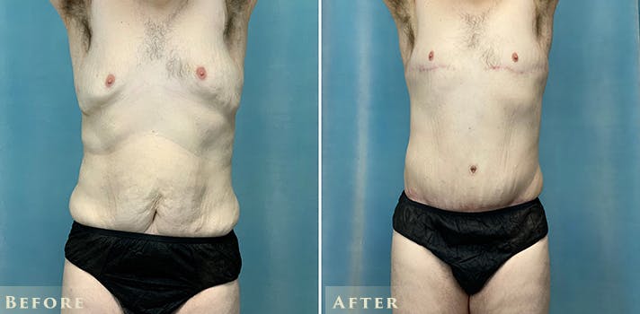 Male Liposuction Before & After Gallery - Patient 316126 - Image 1
