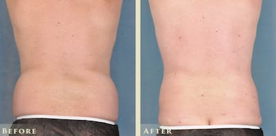 Male Tummy Tuck Before & After Gallery - Patient 414478 - Image 7