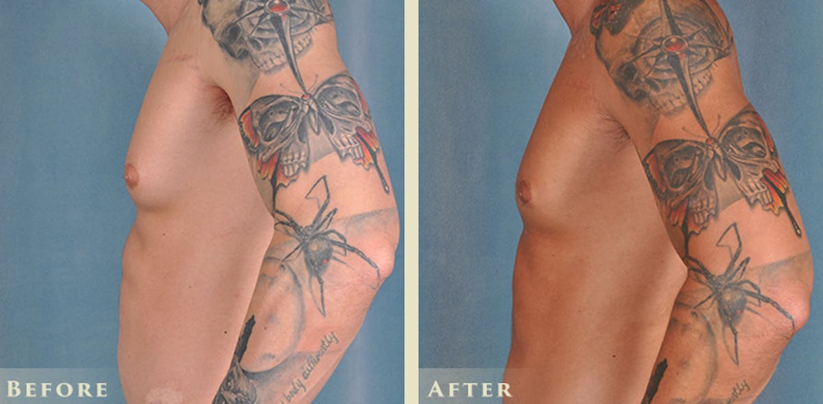 Male Breast Reduction (Gynecomastia) Before & After Gallery - Patient 639084 - Image 3