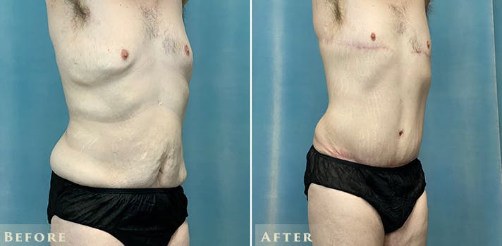 Male Liposuction Before & After Gallery - Patient 316126 - Image 3