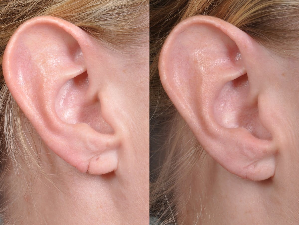 Earlobe Repair Before & After Gallery - Patient 159070 - Image 1