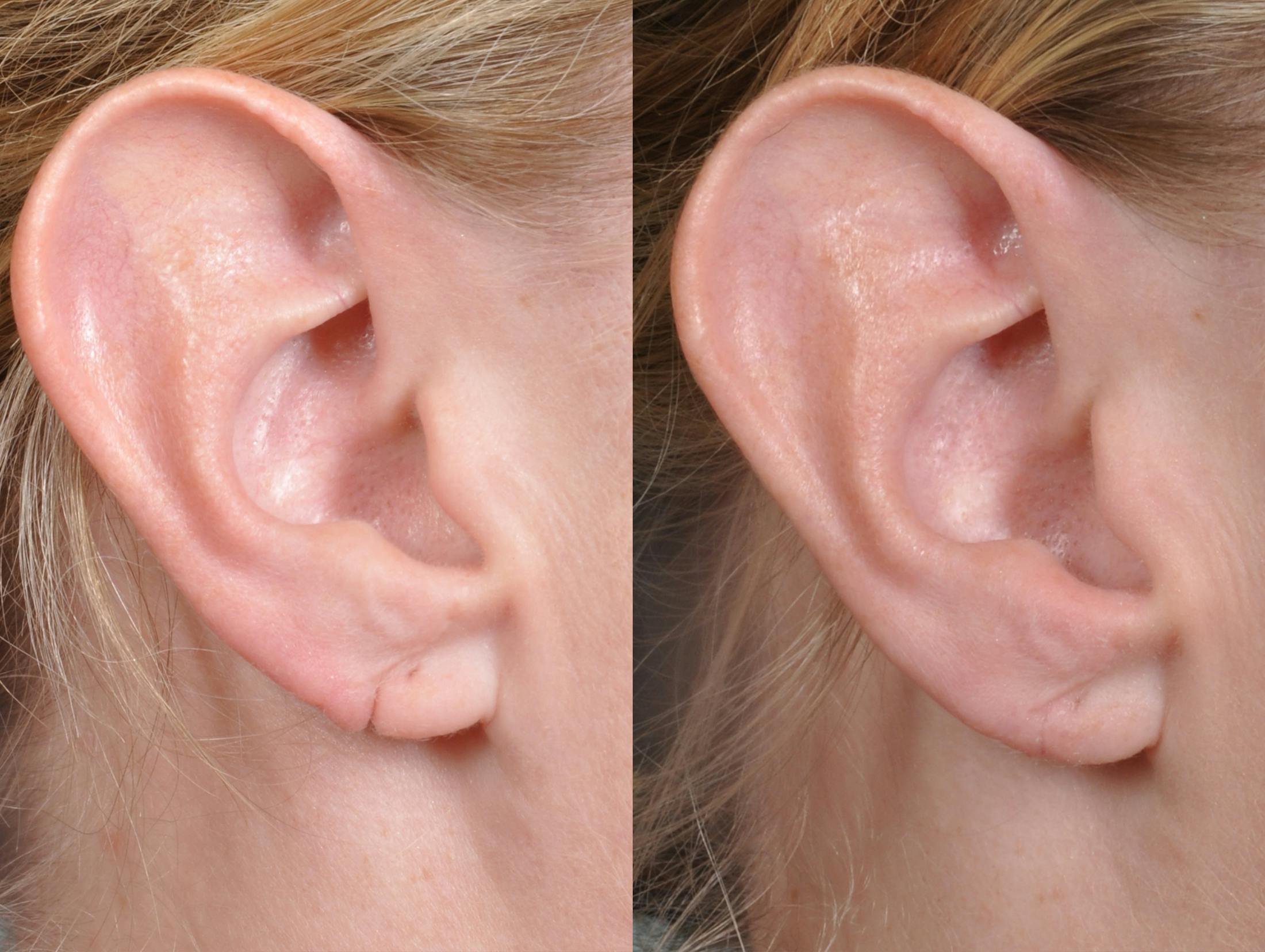 Earlobe Repair Before & After Gallery - Patient 159070 - Image 1