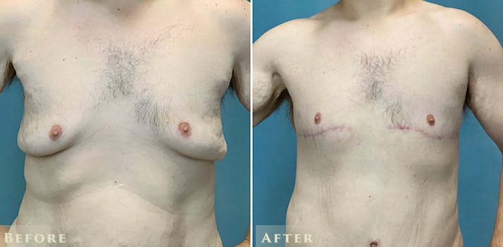 Male Breast Reduction (Gynecomastia) Before & After Gallery - Patient 527424 - Image 2